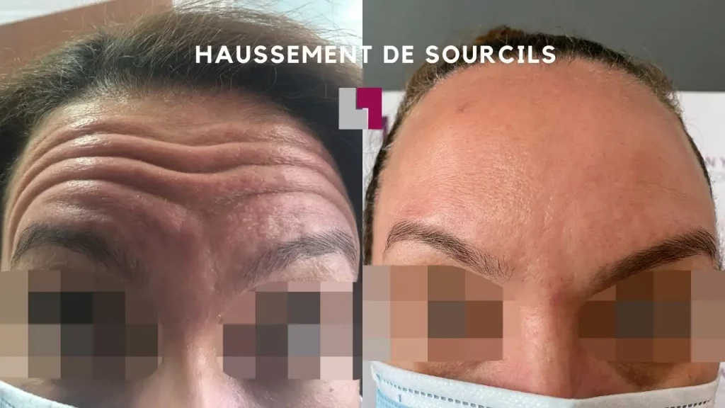 Nathan Yadun Center - Femme Front après injection botox aux haussement sourcils Rouen