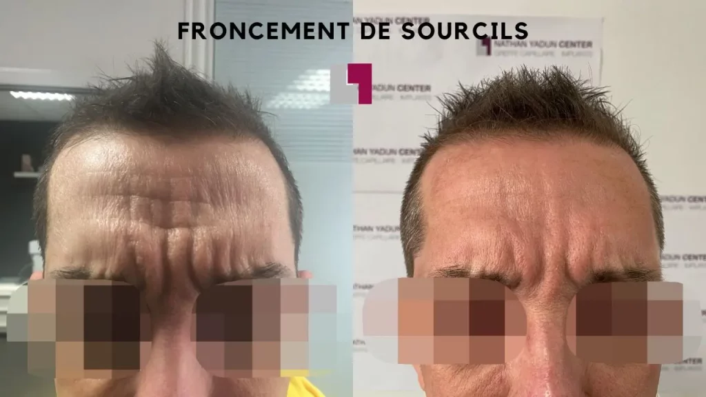 Nathan Yadun Center - Front après injection botox aux froncement sourcils Rouen