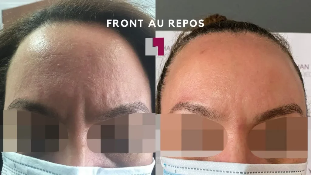Nathan Yadun Center - Femme Front après injection botox aux froncement sourcils Rouen