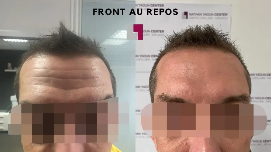 Nathan Yadun Center - Injection botox sur le front homme Rouen