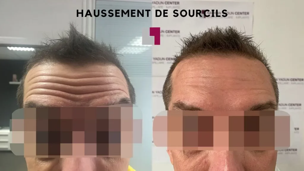 Nathan Yadun Center - Front après injection botox aux haussement sourcils Rouen