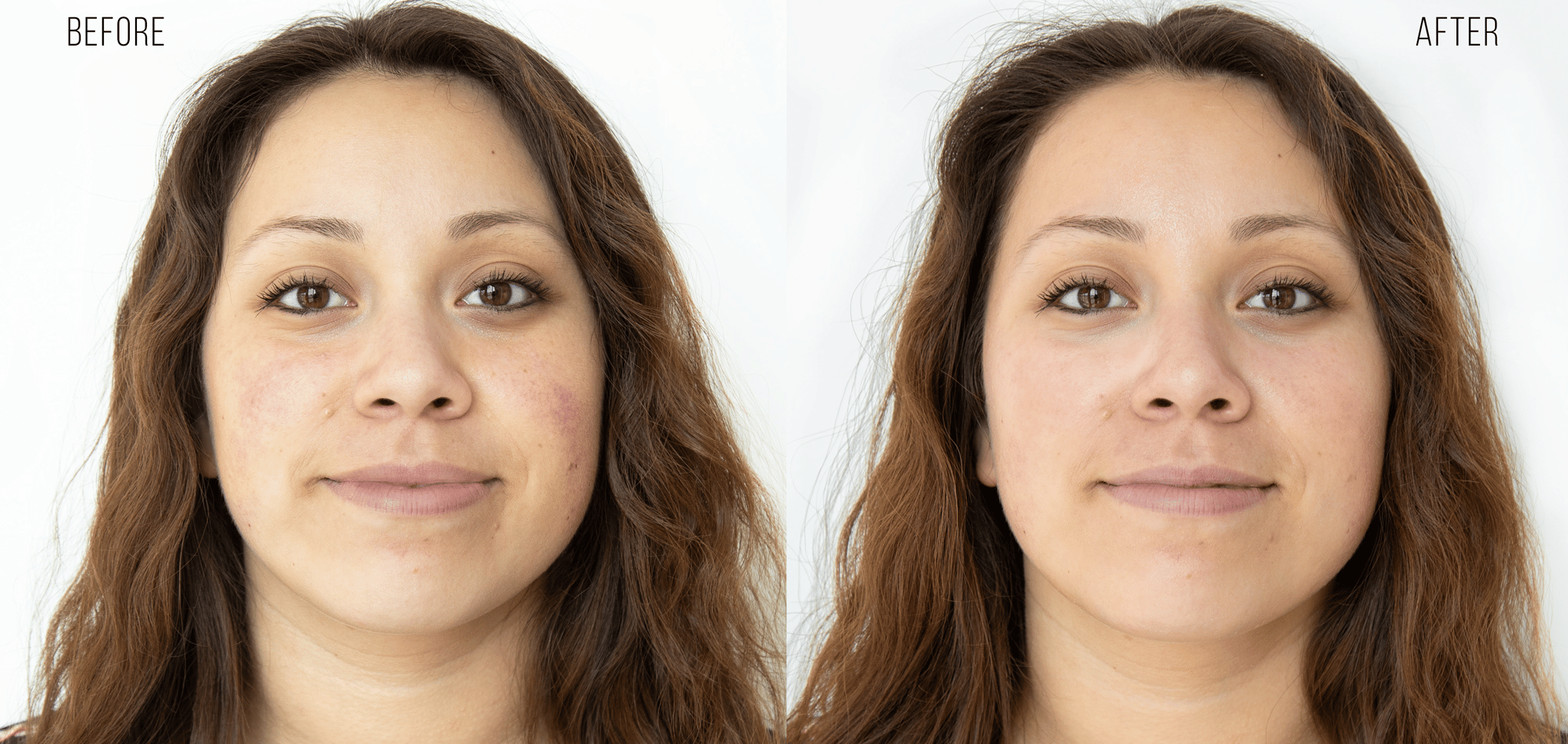 Anomalie texture de peau, inégalités du teint, rougeurs, pores dilatés