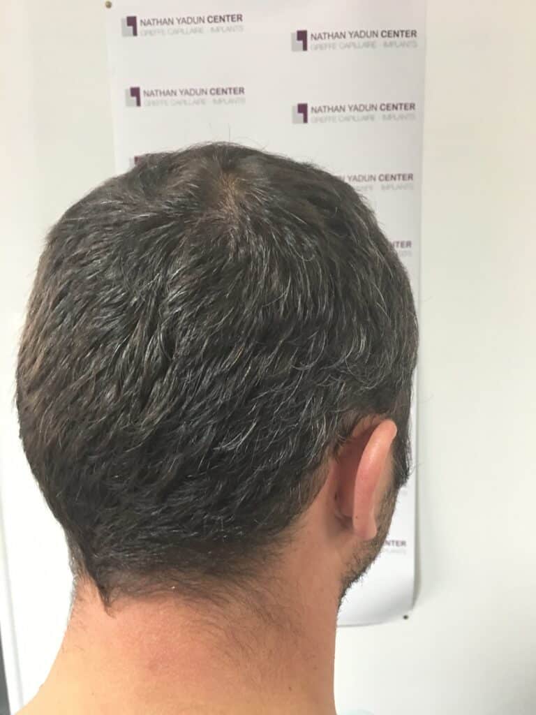 Zone donneuse pour greffe de cheveux Caen
