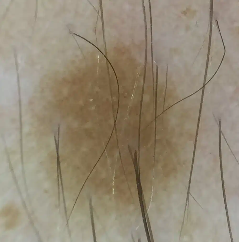 Grain de beauté examiné en dermatoscopie au NY Center à Rouen