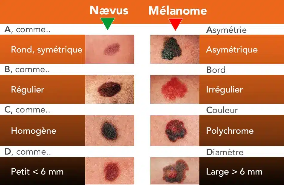 Règle ABCDE : comparaison entre nævus bénin et mélanome